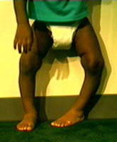 Bowed Legs - Kids Plus Pediatrics