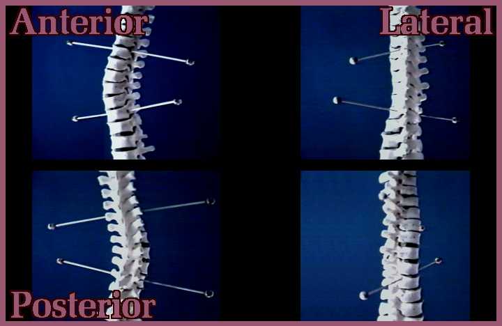 Scoliosis Degrees Of Curvature Chart